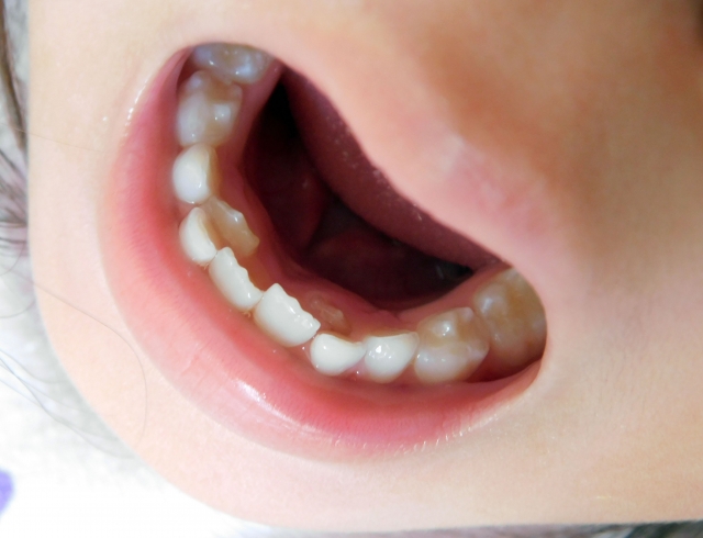 「感染の窓」とは？子どもがむし歯になりやすい時期を解説