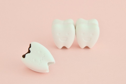 【むし歯の進行段階】C0～C4までの違いと治療法をわかりやすく解説！